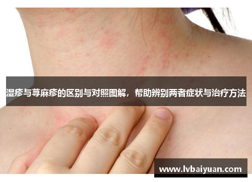 湿疹与荨麻疹的区别与对照图解，帮助辨别两者症状与治疗方法